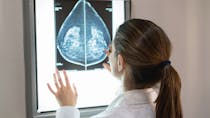 L'IA peut prédire l'efficacité de la chimiothérapie du cancer du sein
