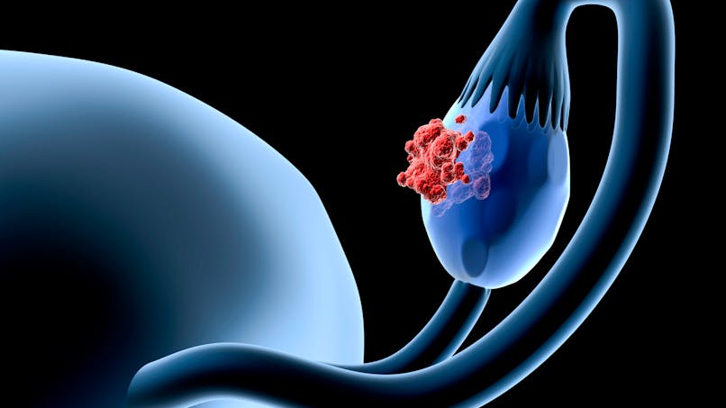 Cancer de l’ovaire : une nouvelle immunothérapie donne des résultats encourageants