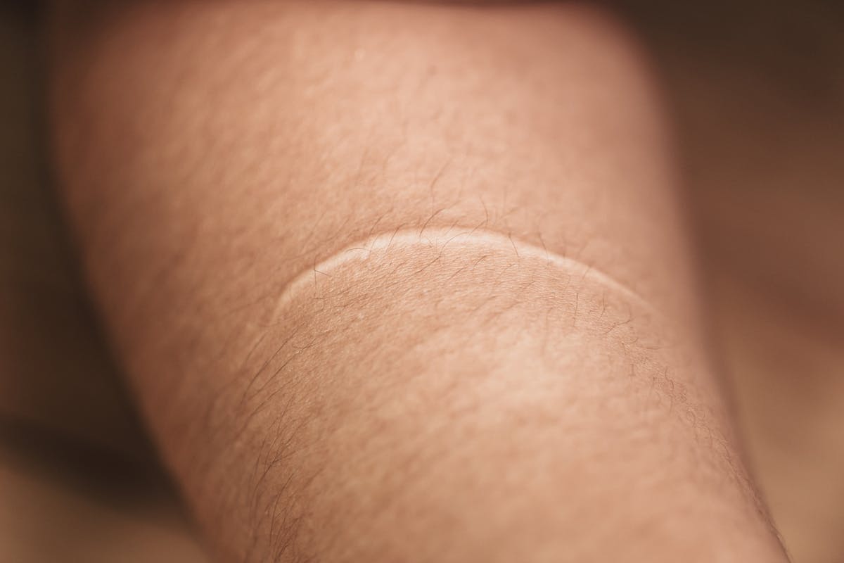 Cicatrice ancienne : les solutions pour l'effacer | Santé Magazine