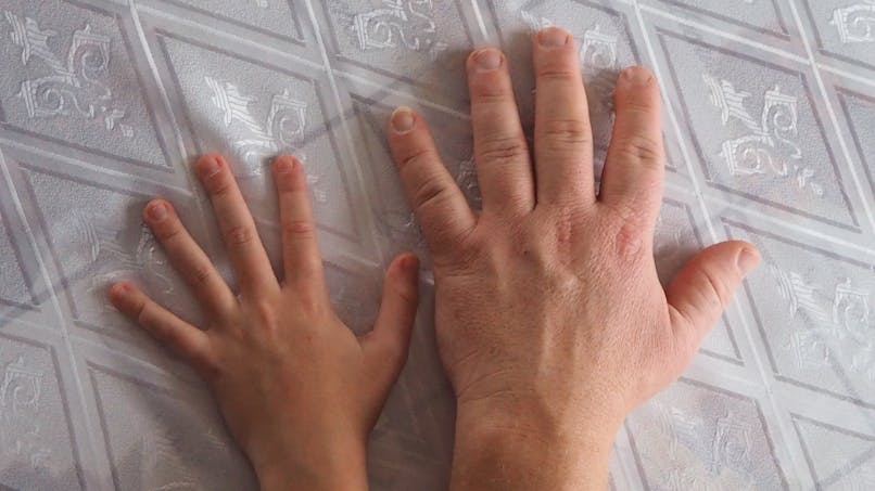Mains déformées à cause d'une acromégalie