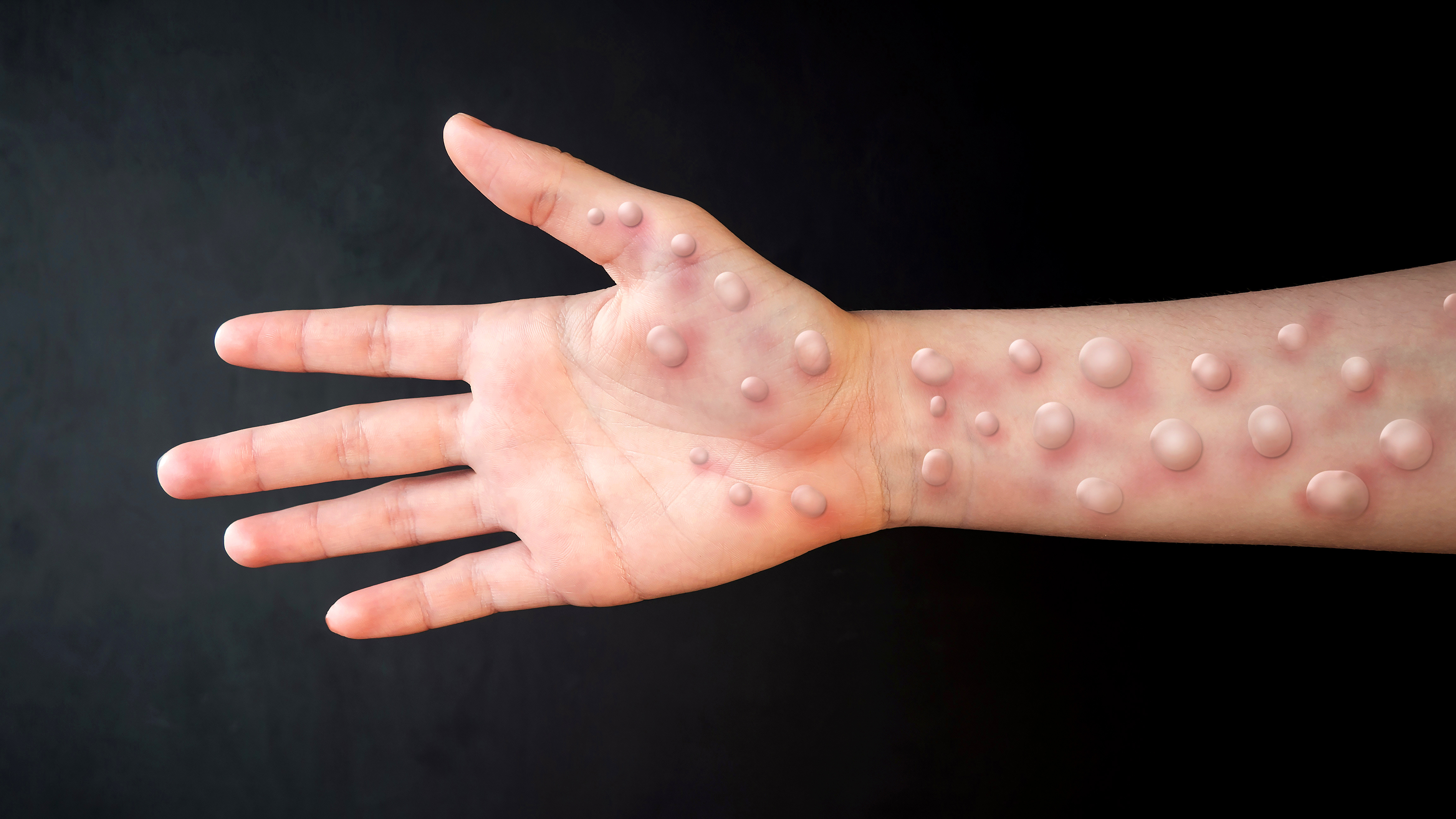 Variole : tout comprendre sur cette maladie éradiquée | Santé Magazine
