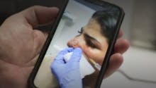 Injection illégale : elle a failli perdre son nez après une injection d’acide hyaluronique