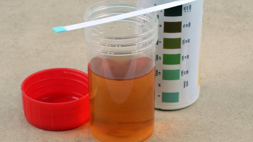 urine-analyse-test-bandelette-infection-urinaire