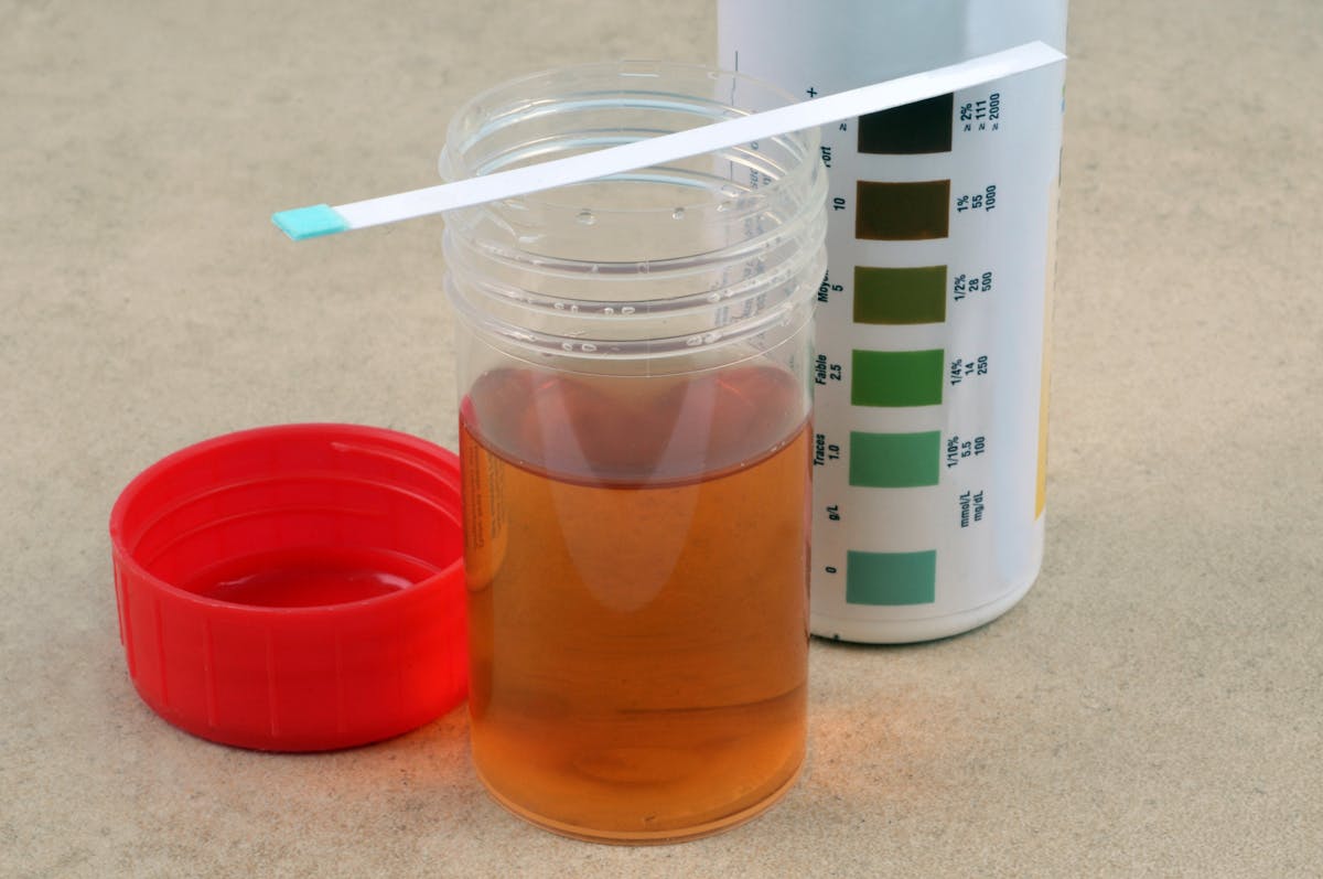 Autotests urinaires - AUTOMESURE Il est possible d'analyser soi-même les  urines à l'aide de bandelettes urinaires. C'est simple et utile dans  plusieurs situations. Le résultat de ces autotests doit souvent être  confirmé