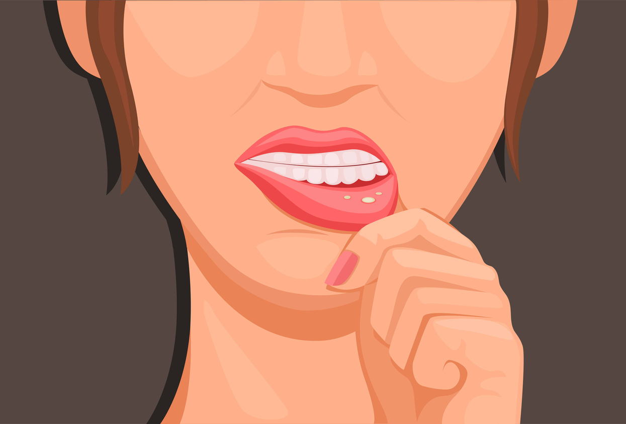 Stomatite : causes et traitements de cette inflammation de la bouche |  Sant Magazine