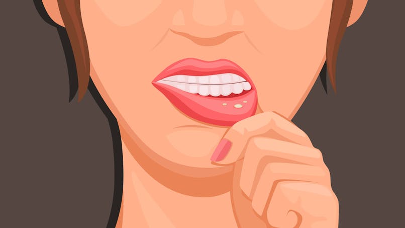Stomatite : symptomes, traitements de cett inflammation de la bouche
