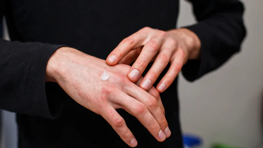 Comment reconnaitre l'Urticaire : plaques rouges, gonflées et qui ...
