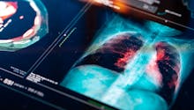 Le cancer des poumons bientôt prédit par un nouveau programme informatique