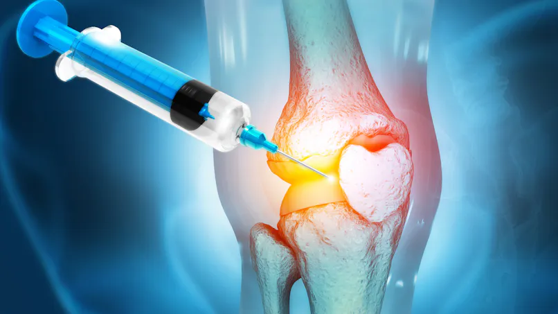 Arthrose du genou : une nouvelle thérapie cellulaire injectable fait ses preuves