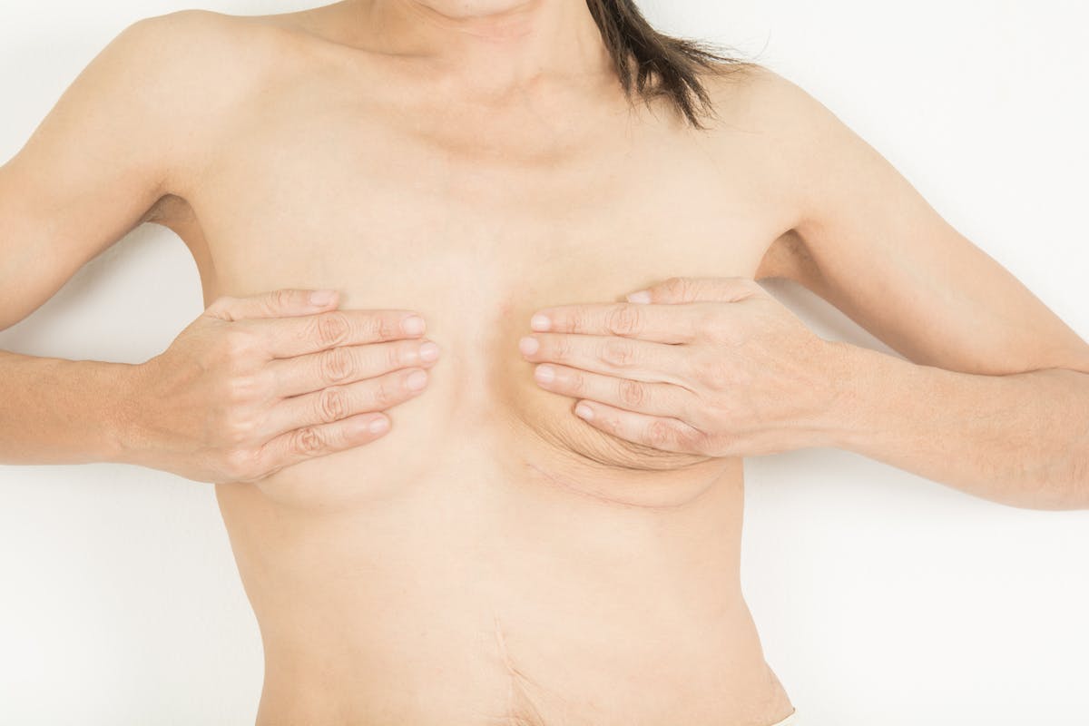 Tout savoir sur les cicatrices d'une mastectomie | Santé Magazine