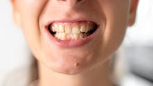 Malocclusion dentaire : quand les dents sont mal alignées