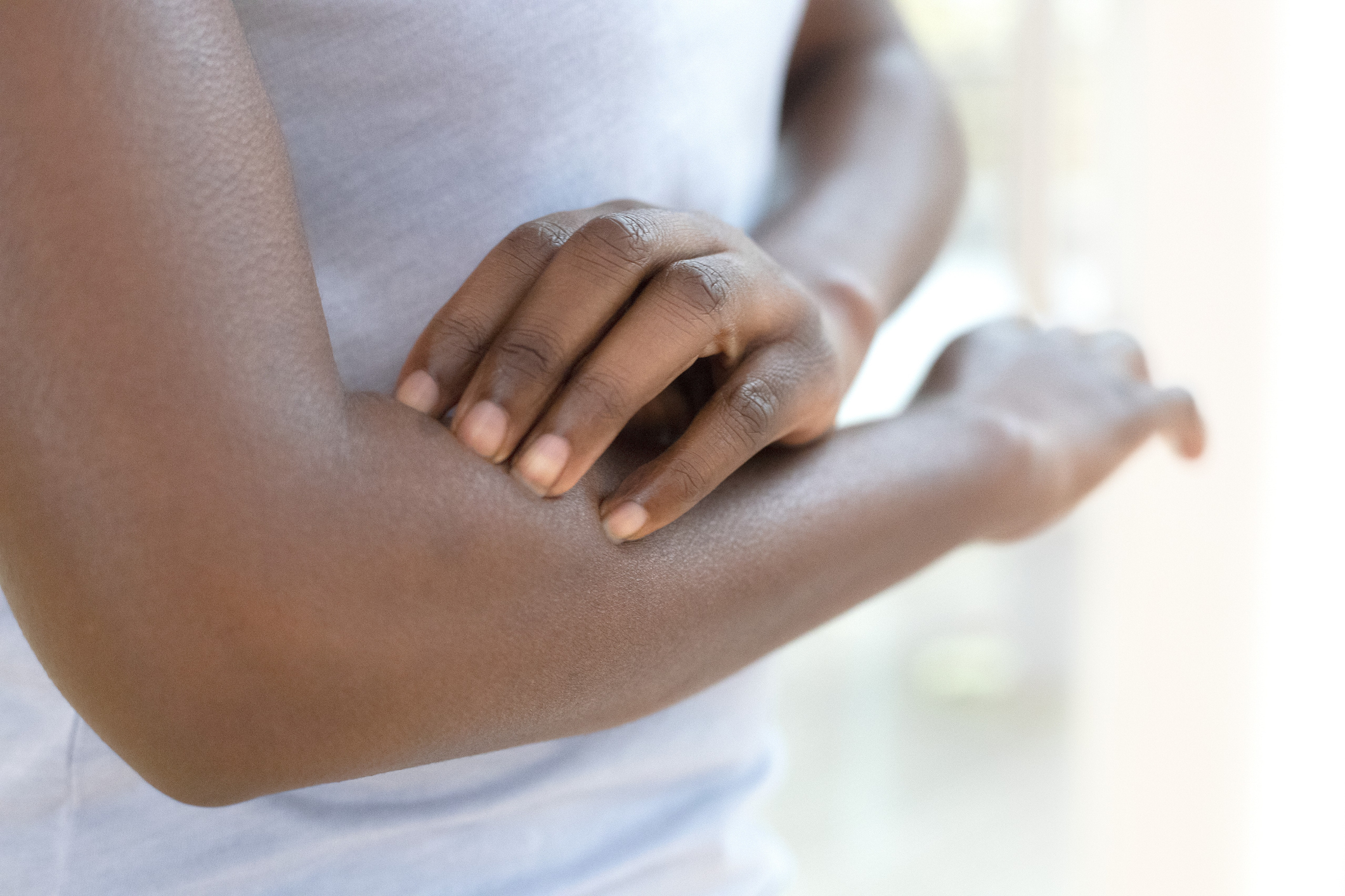 Eczéma sur une peau noire : taches, dartres, que faire ? | Santé Magazine