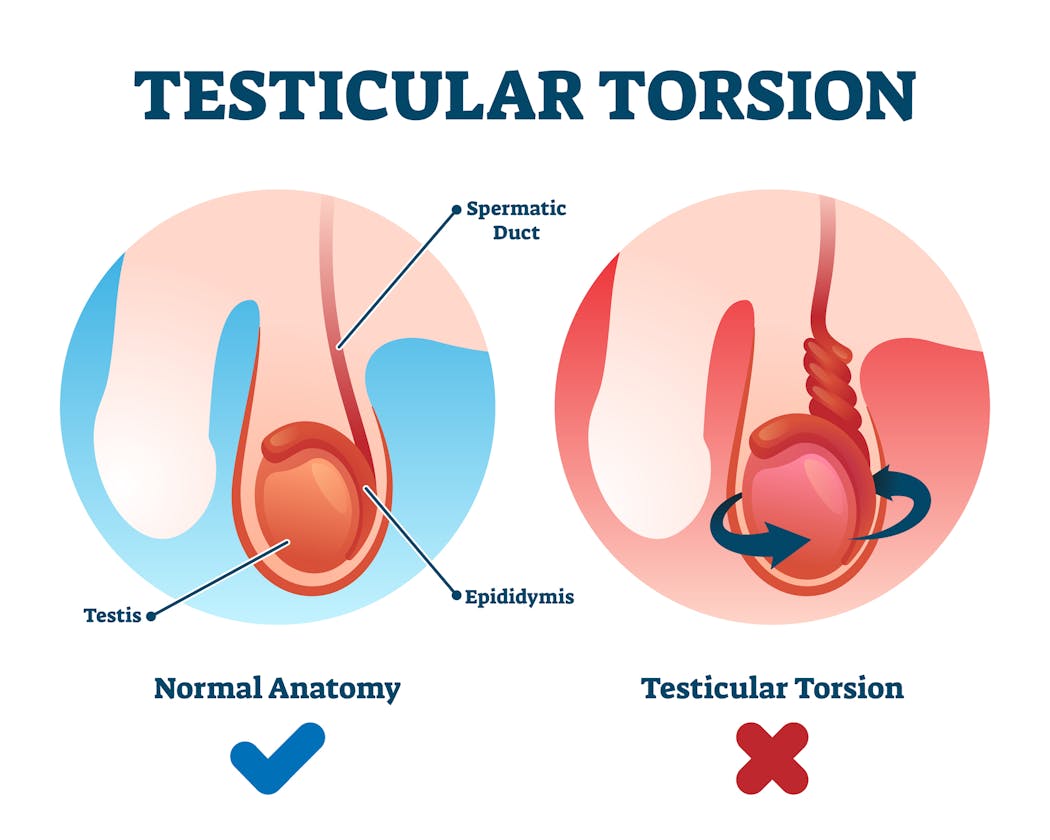 schéma d'une torsion testiculaire