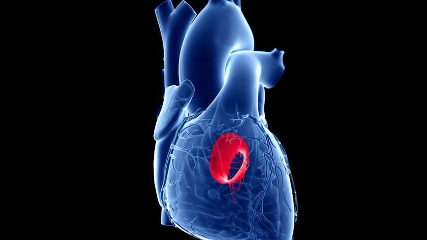 Insuffisance mitrale : quand une valve cardiaque se met à fuir 