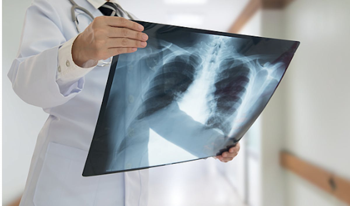 Radiographie pulmonaire : indications, déroulé, résultats | Santé ...