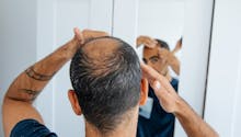 Pourquoi les hommes perdent leurs cheveux ?