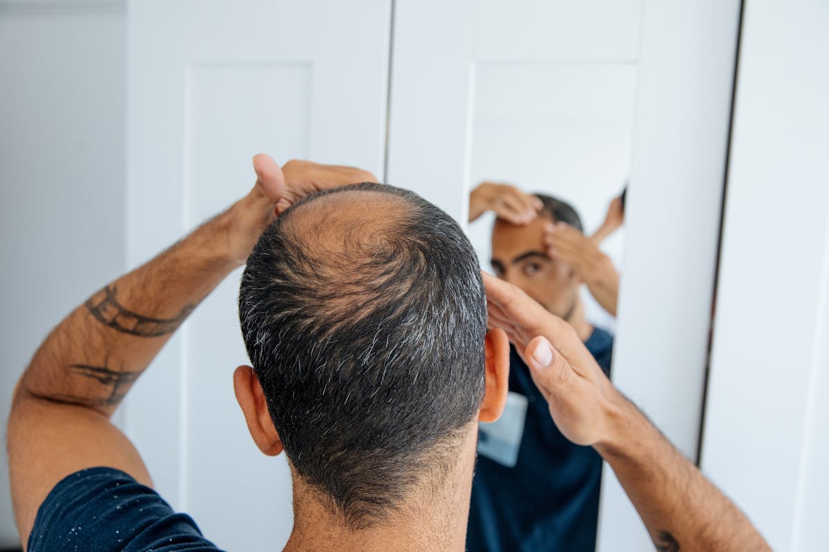 Pourquoi les hommes perdent leurs cheveux ? | Santé Magazine