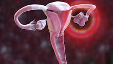Selon une étude, ce trouble cognitif serait associé au syndrome des ovaires polykystiques (SOPK)
