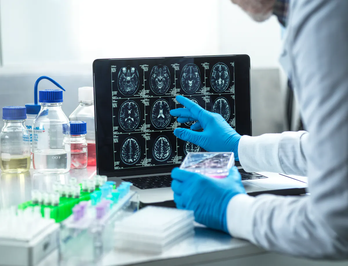 Des chercheurs révèlent des liens entre la maladie d’Alzheimer, les ...
