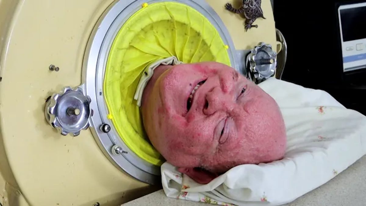 Death of Paul Alexander, who lived in an iron lung: why was this respiratory assistance used?