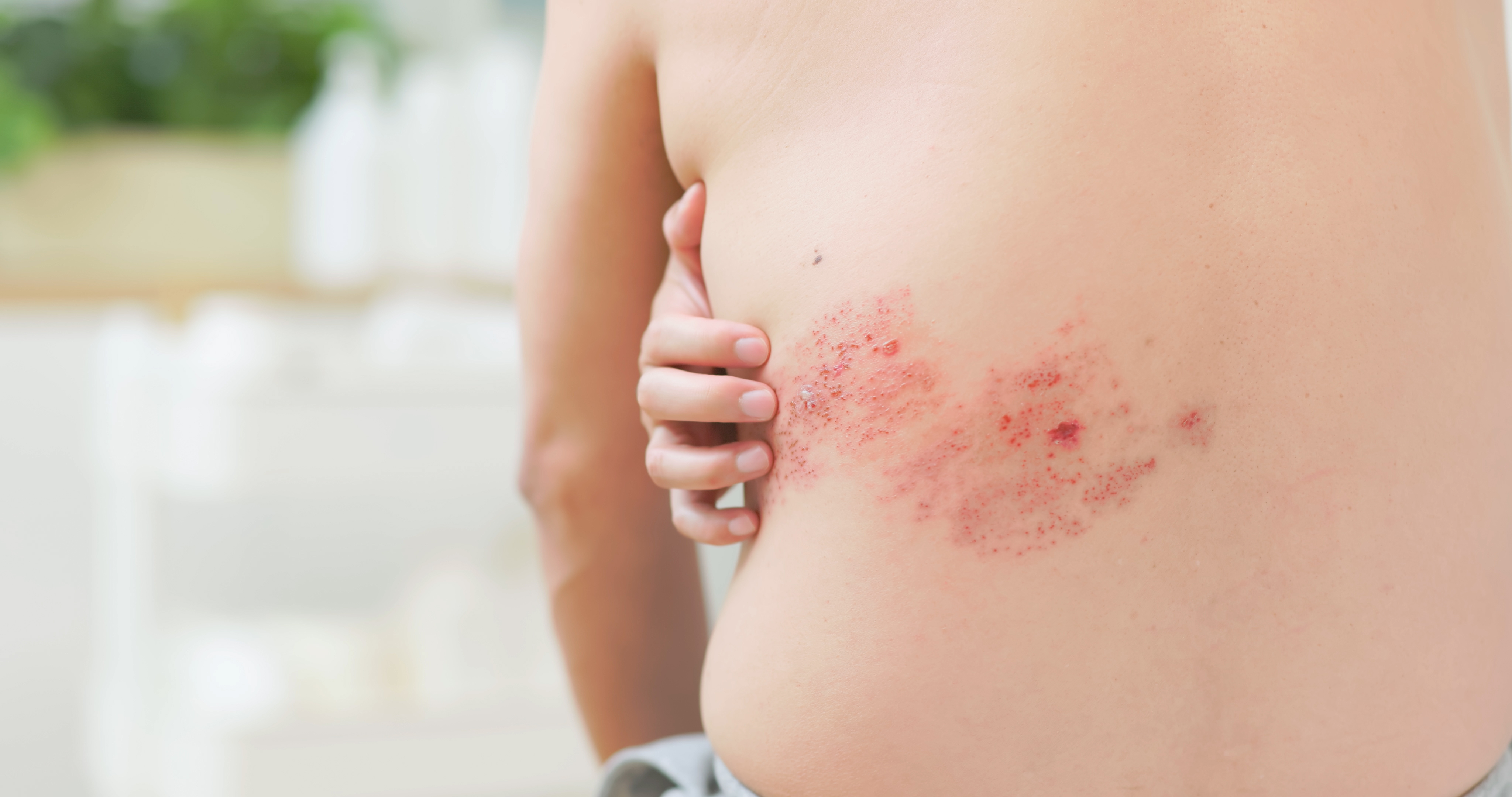 Zona : dfinition, causes, symptmes, complications, traitements | Sant  Magazine