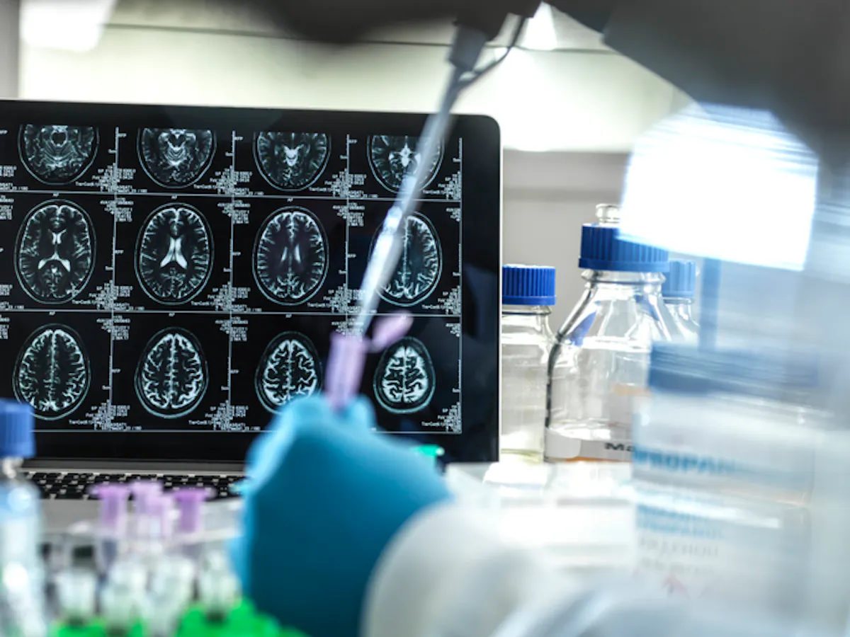 Bientôt un traitement contre le cancer du cerveau le plus meurtrier ...