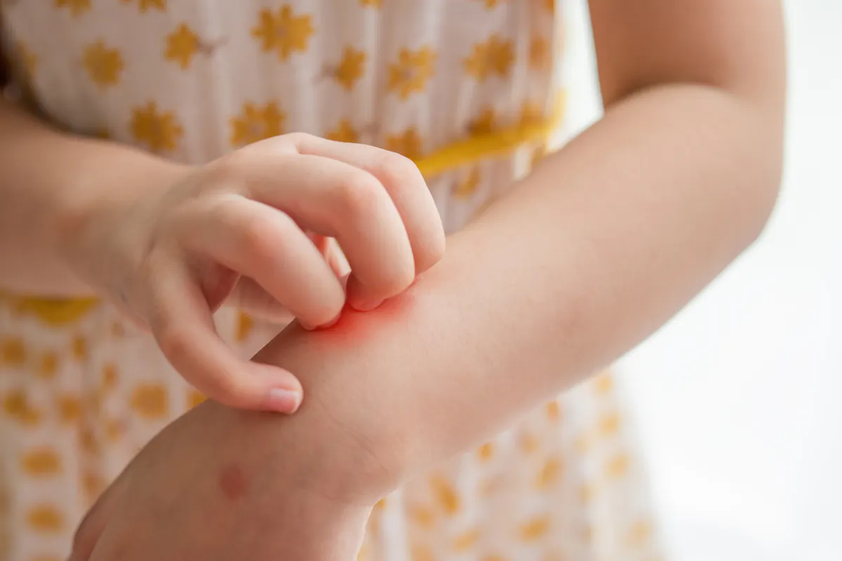 allergie-aux-piq-res-de-moustique-comment-la-reconna-tre-sant