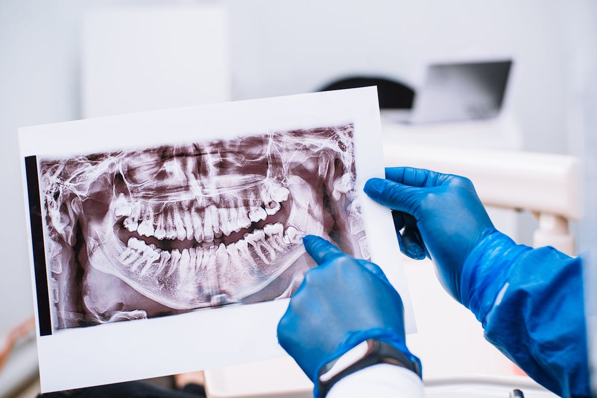 Extraction des dents de sagesse : que manger après ? | Santé Magazine