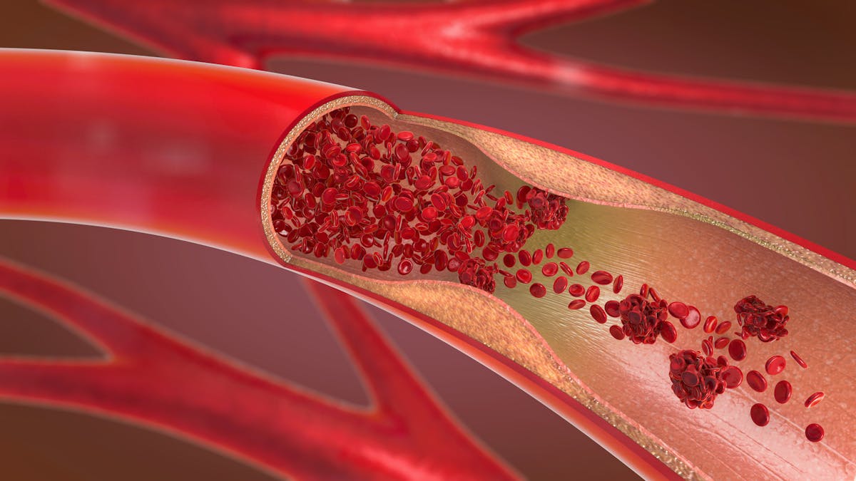 Artery: why and how does it weaken with age?