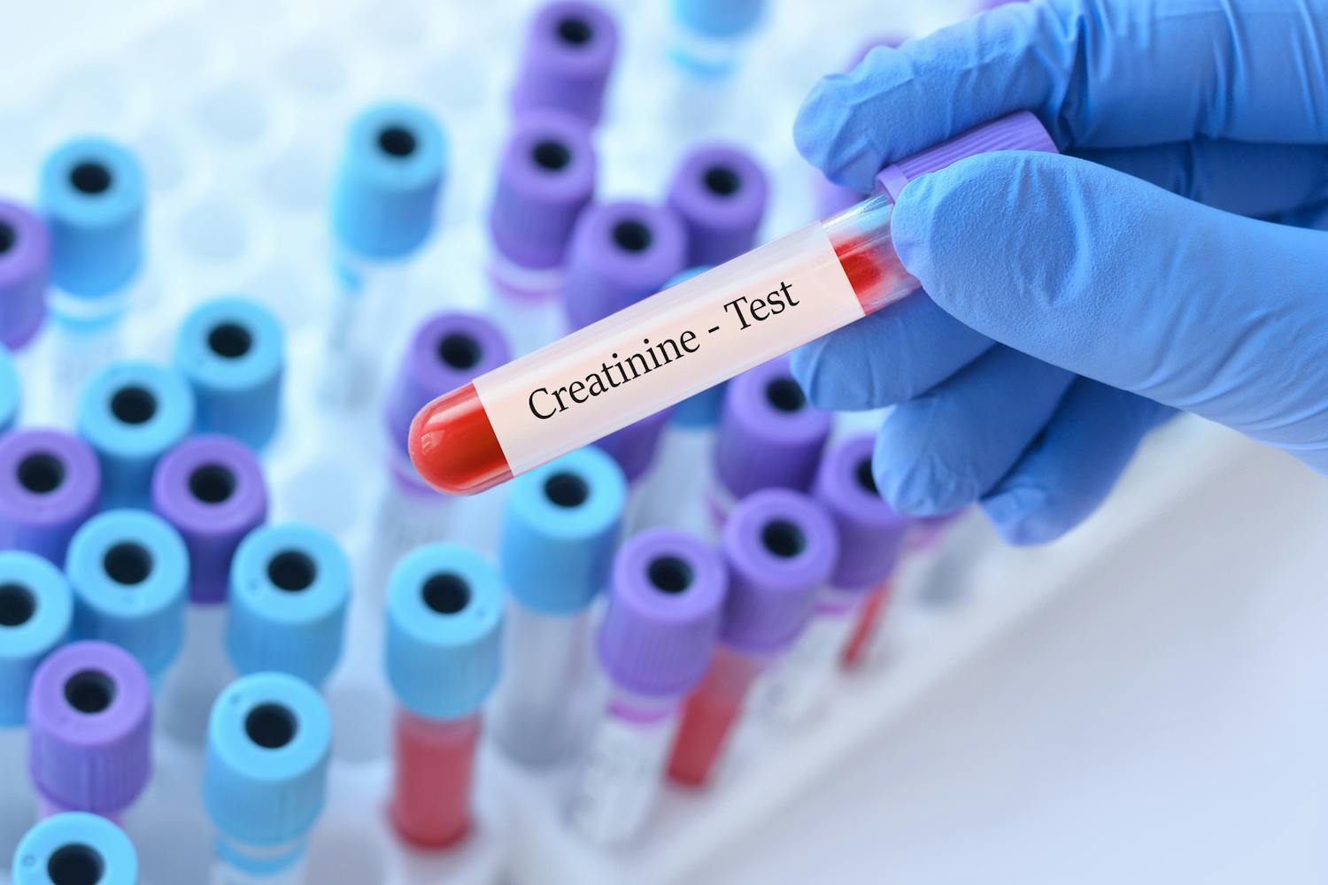Créatinine : quels sont les taux normaux et quand faut-il s'inquiéter ?