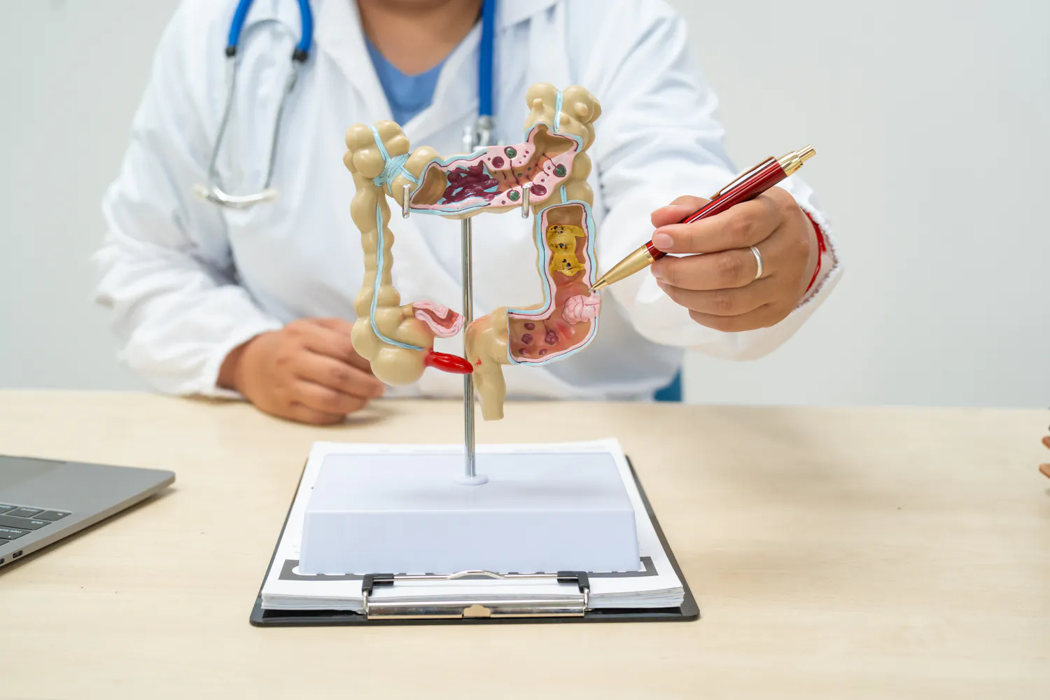Quels sont les symptômes du cancer du côlon ?