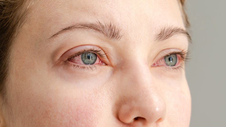 Conjonctivite : causes, contagion,symtômes, traitement | Santé Magazine