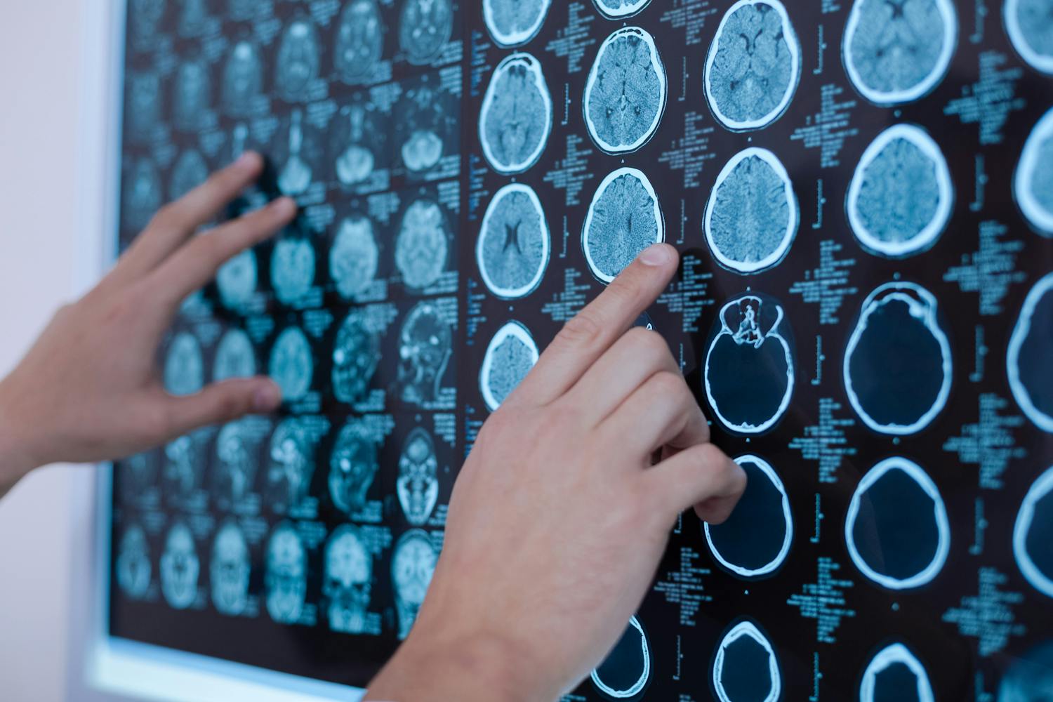 Dépression résistante : et si la solution pour la traiter était de recourir aux ultrasons ?