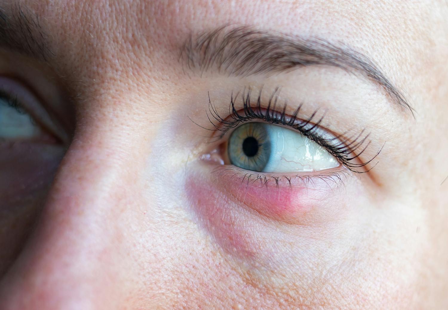 Gonflement sous l'œil : quelles causes ? Que faire ?