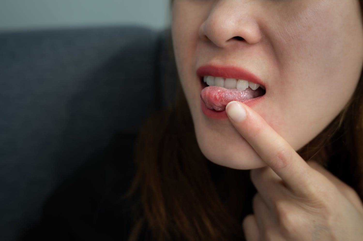 Aphte sur la langue : comment s'en débarrasser (et quand consulter) ?