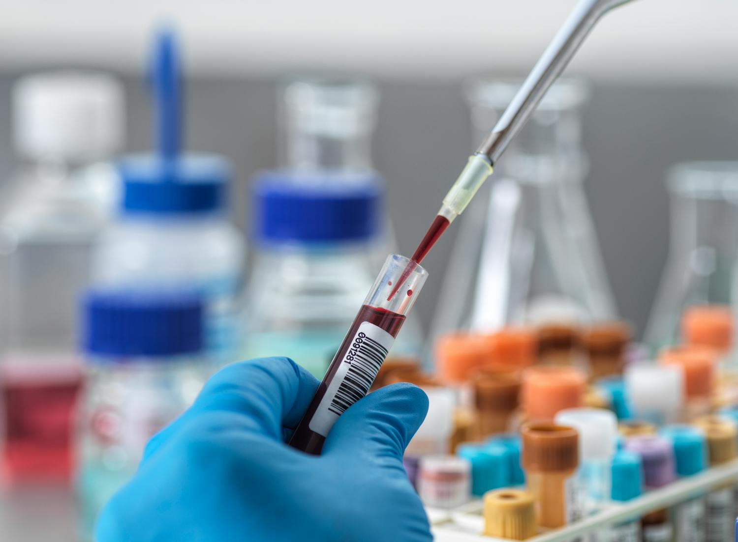 Immunoglobulines G (IgG) : définition, rôle, dosage