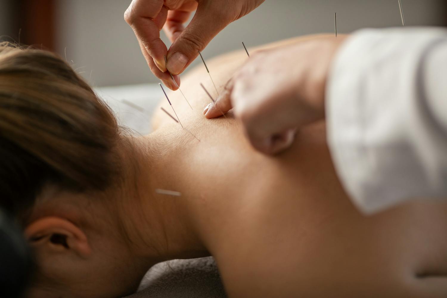 L'acupuncture est-elle efficace sur la douleur ?