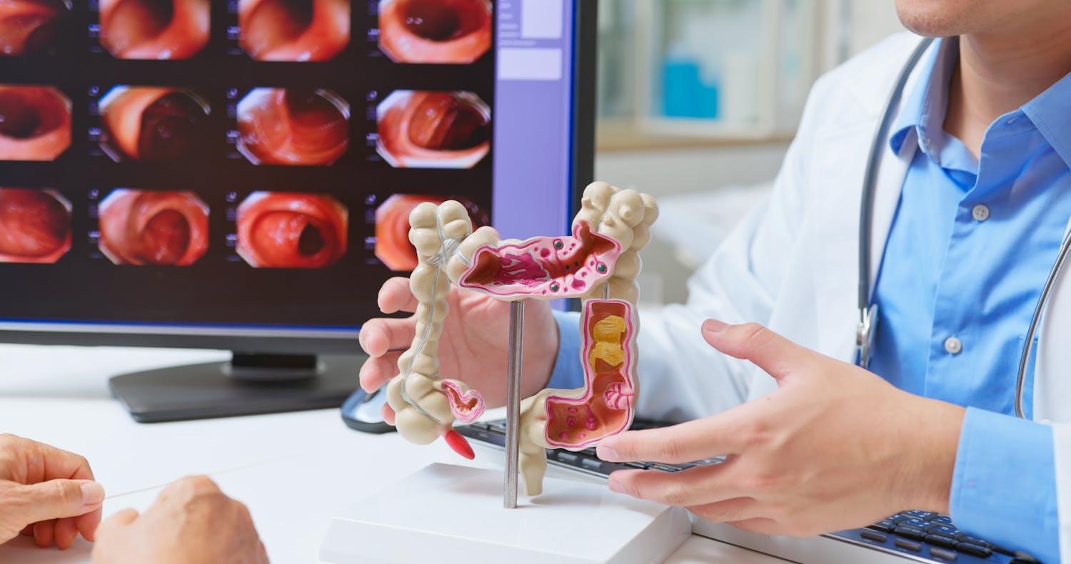 Voici quand est-ce qu'on peut être considéré comme guéri après un cancer du côlon