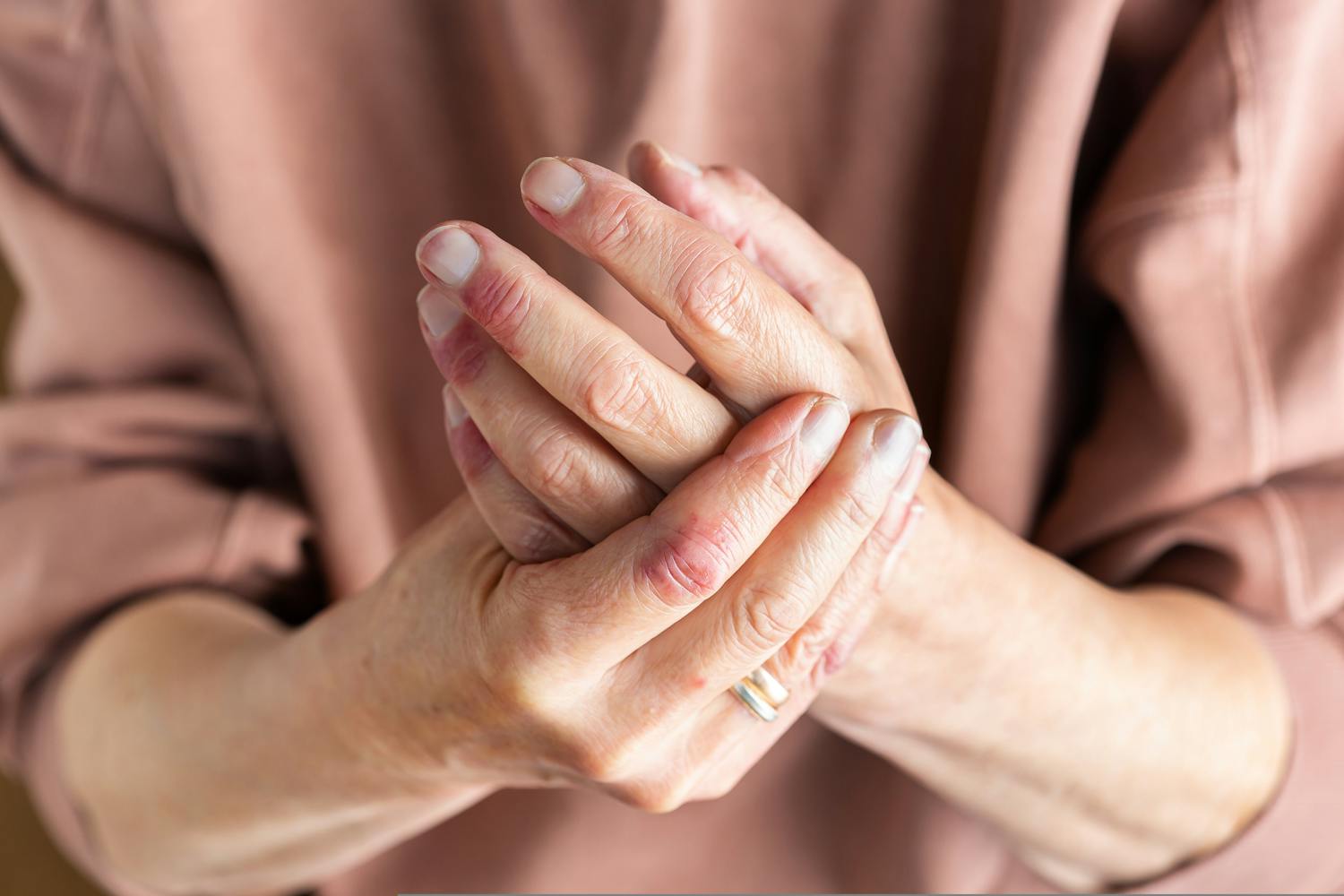 Psoriasis mains-pieds : le tabagisme augmente le risque