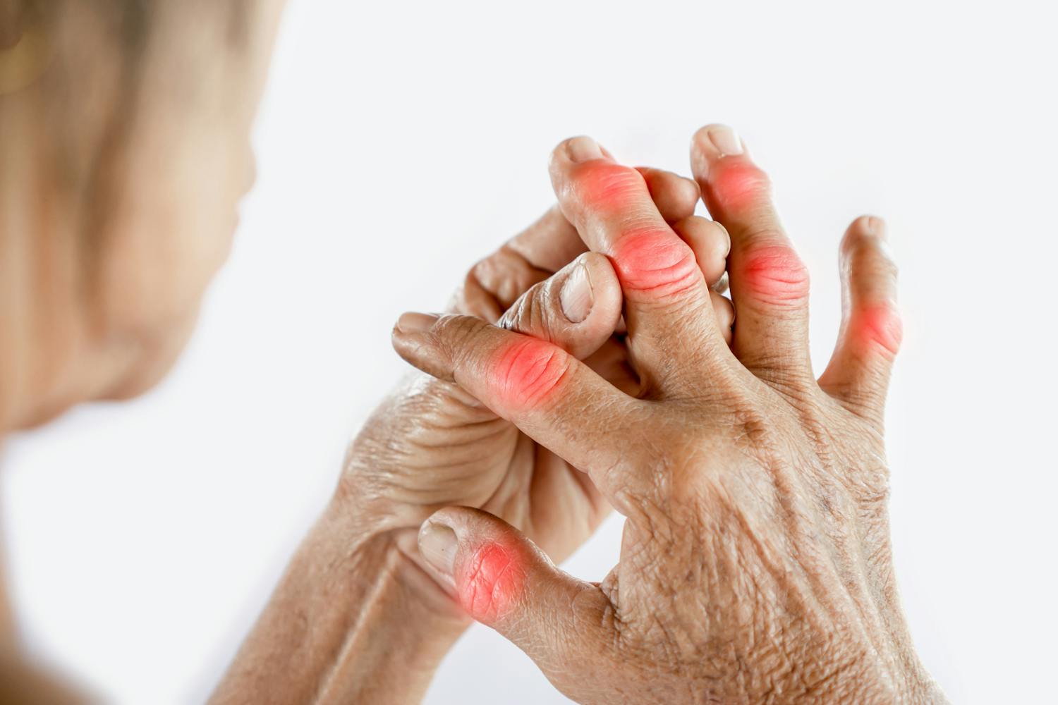 Arthrite du doigt : causes , symptômes, traitements