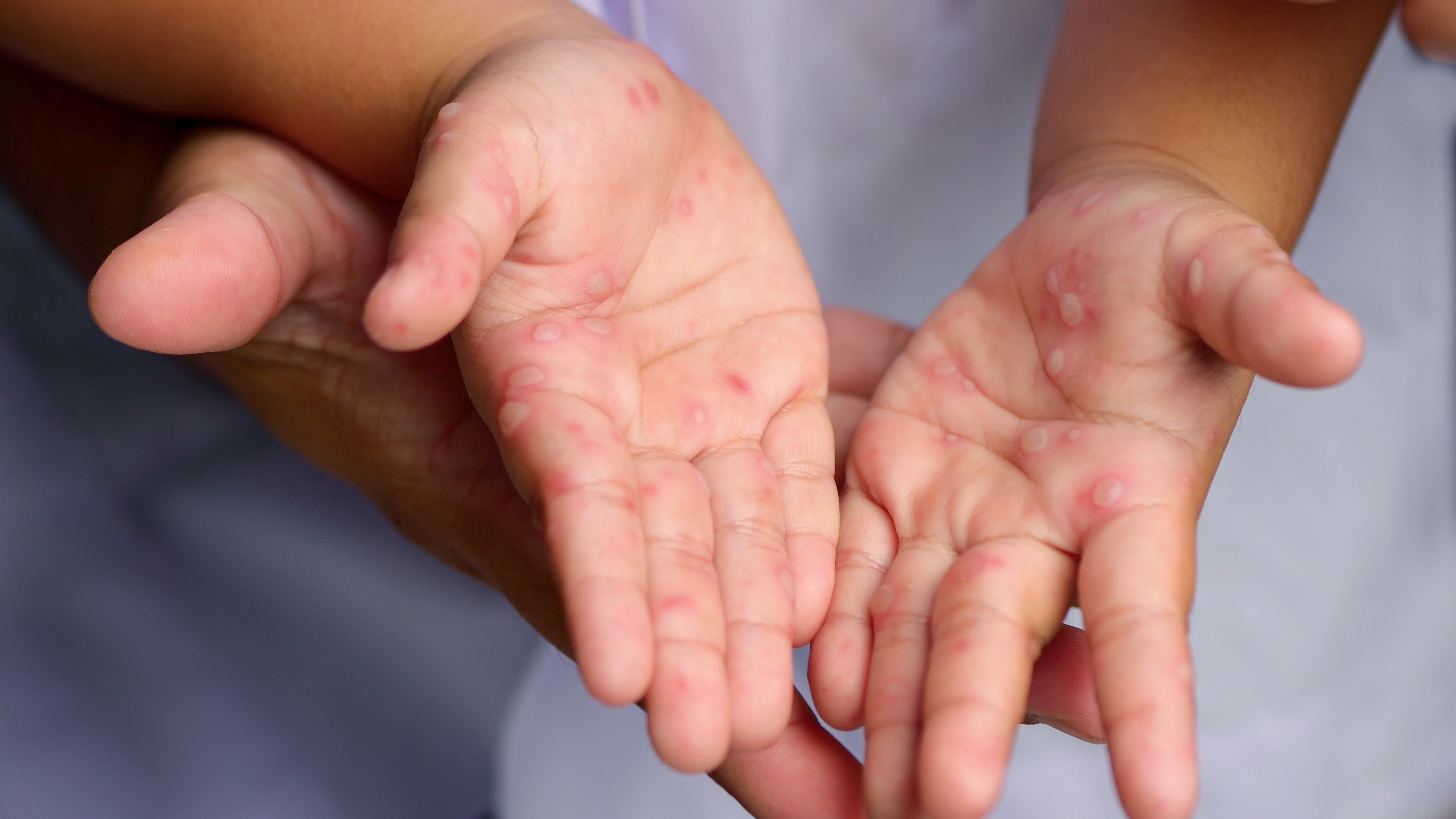 Un bébé meurt de la scarlatine à la suite d'une erreur médicale aux urgences