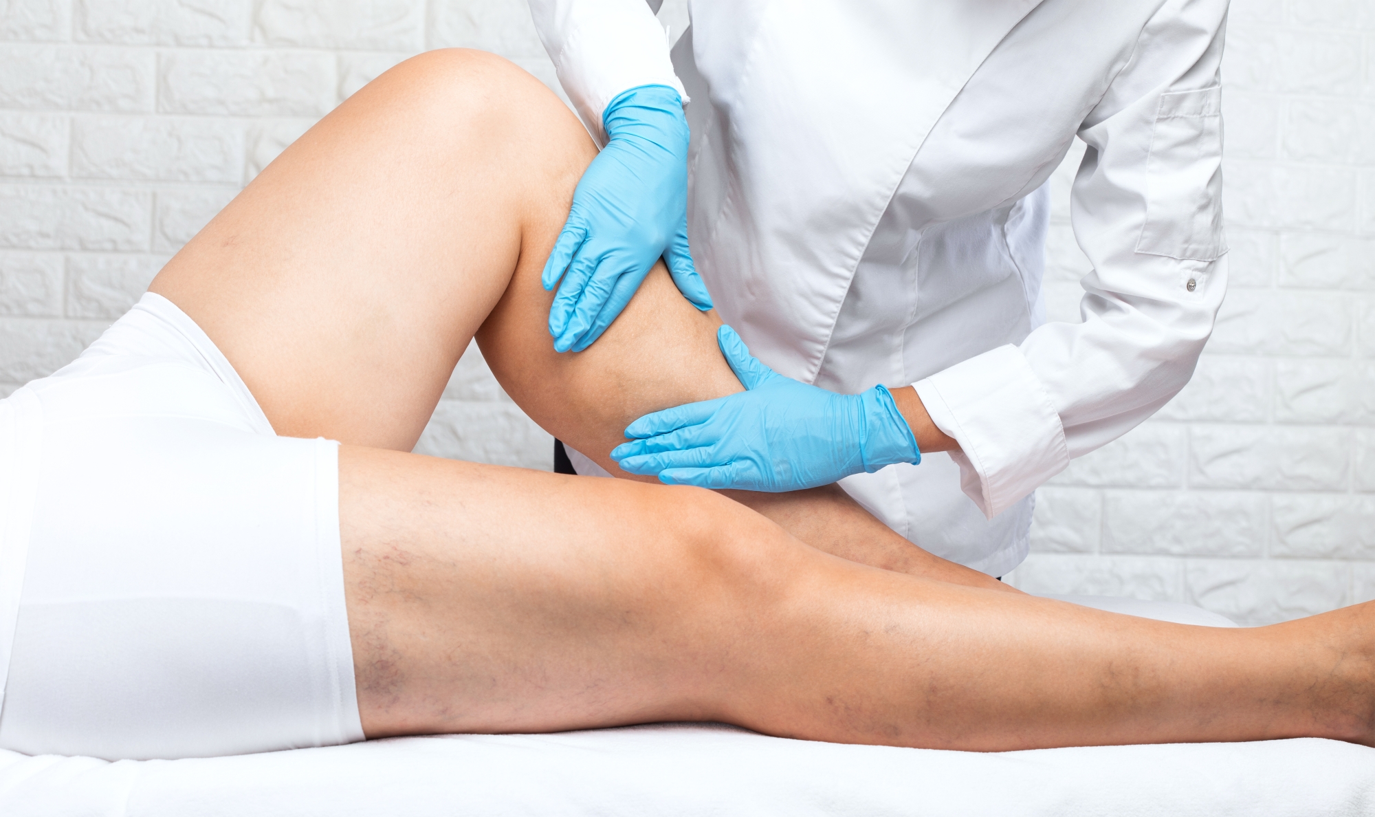 Traitements contre les varices : l'Agence du médicament rappelle les bonnes pratiques