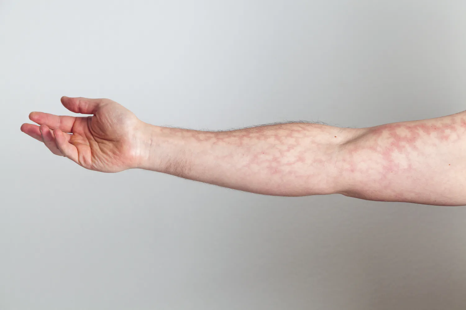 Peau marbrée : faut-il s'inquiéter ?