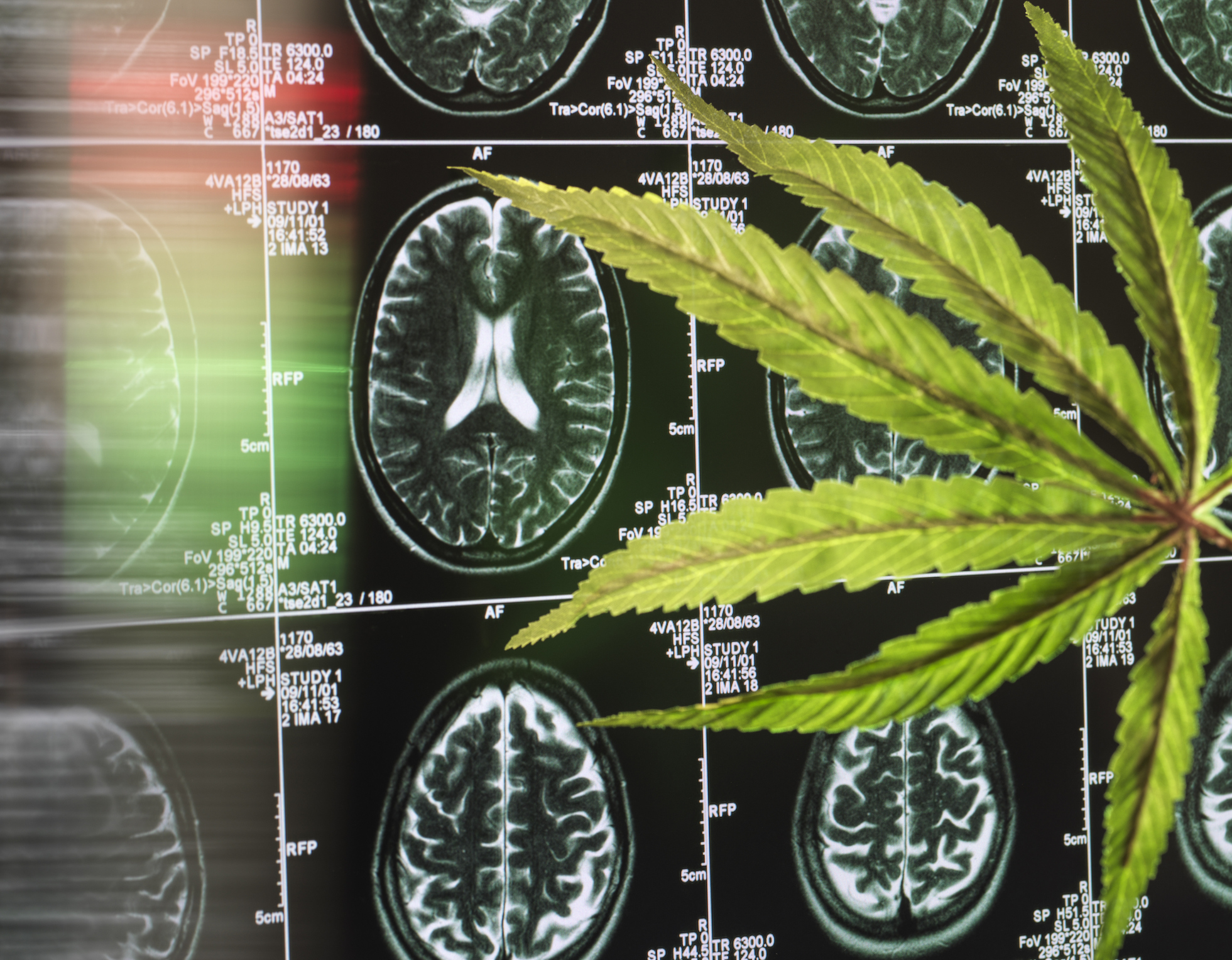 La consommation de cannabis ferait rétrécir une partie du cerveau