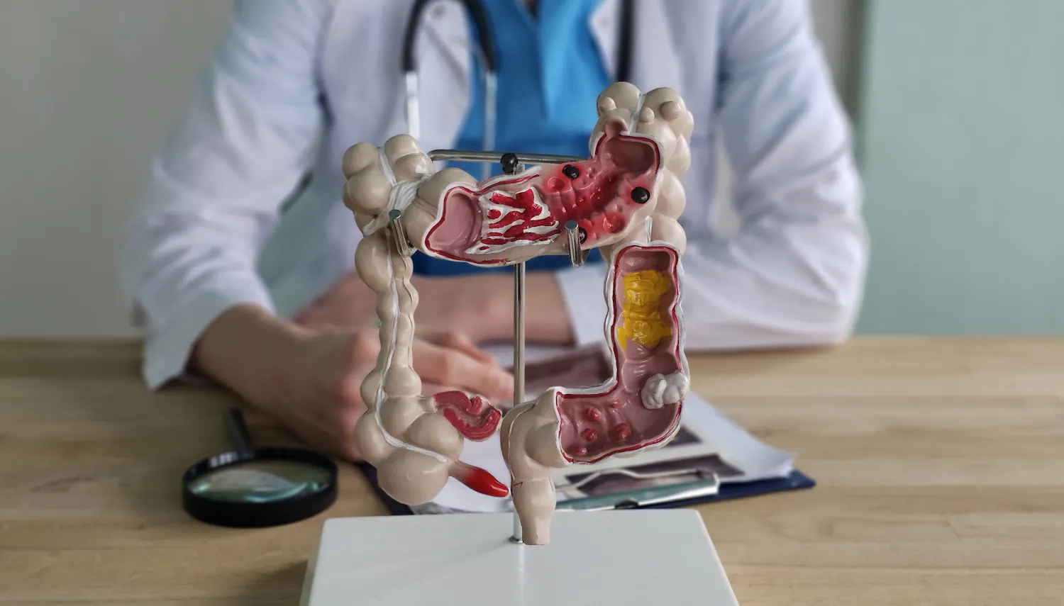 Symptômes : comment commence un cancer du côlon ?