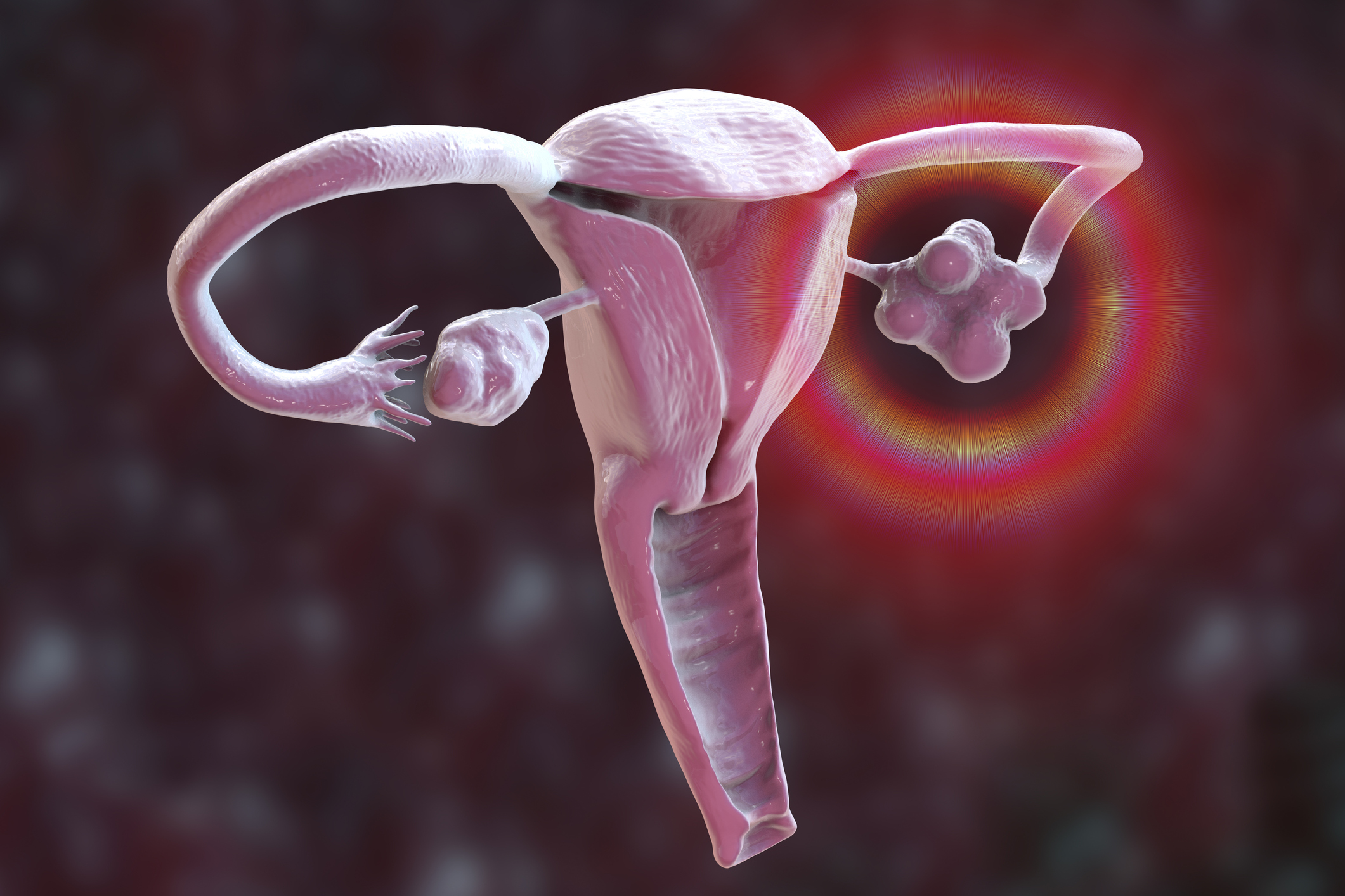 Syndrome des ovaires polykystiques : le SMOP, un terme plus exact et adapté