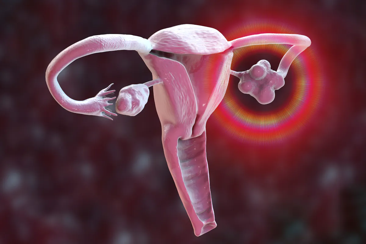 Syndrome des ovaires polykystiques : le SMOP, un terme plus exact et adapté