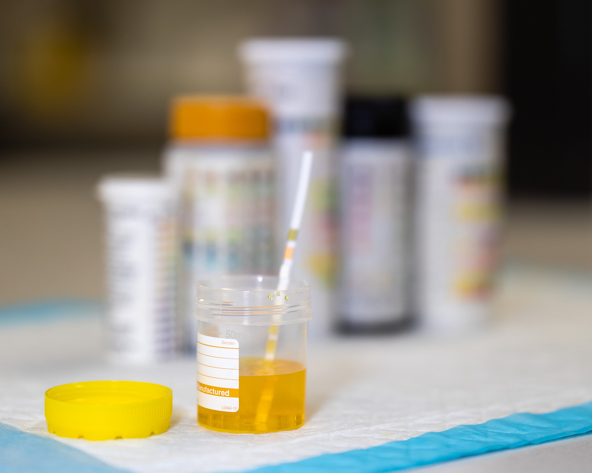 Cystite : les autotests urinaires sont-ils vraiment fiables ?